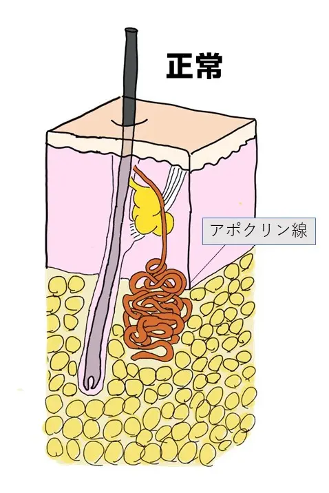 わきが（腋臭症） | 大阪市阿倍野区の皮膚科・形成外科・美容皮膚科