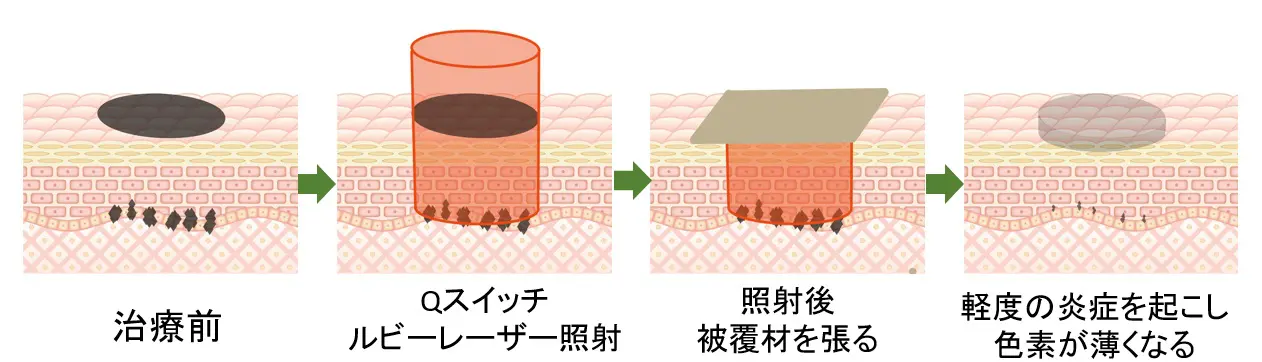 Qスイッチルビーレーザー治療 | 大阪市阿倍野区の皮膚科・形成外科・美容皮膚科
